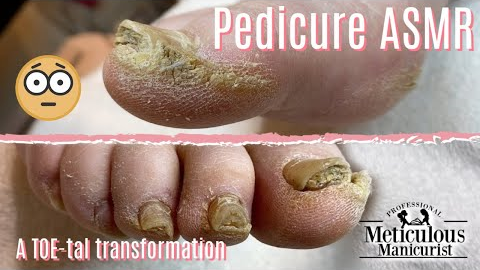 👣Pedicure ASMR on Extremely Calloused Feet👣