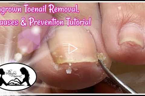 👣 Ingrown Toenail Removal Causes and Prevention Pedicure Tutorial 👣