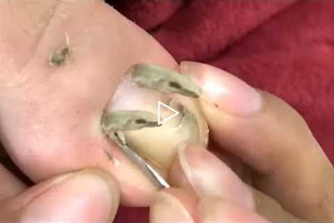 HOW TO CUT THICK TOENAILS  - Toenail Cleaning Satisfying #28