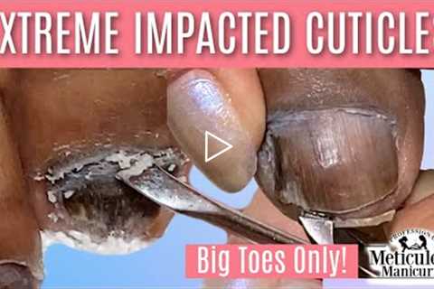 👣Big Toes Only - Extreme Cuticle Impacted Removal ASMR Pedicure👣