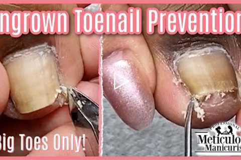 👣Pedicure How To on Ingrown Toenail Pain, Cleaning, and Prevention 👣