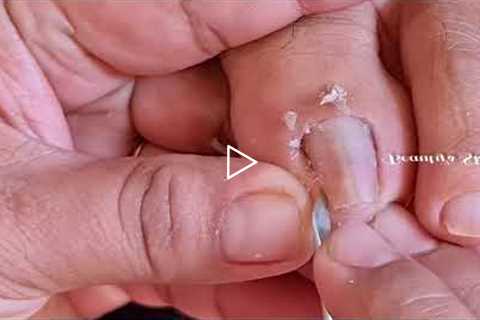 How to remove the cuticle and ingrown properly?|Satisfying pedicure(Part1) | Beauty's Skills