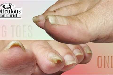 👣Big Toes Only - THICK Pincer Toenail Pedicure👣