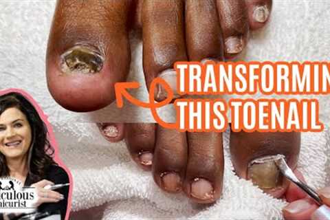 👣Toenail Cleaning Transformation👣