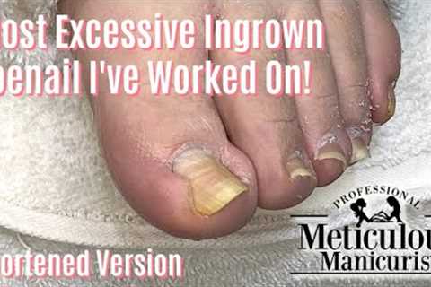 👣Most Extreme Ingrown Toenail Salon Pedicure - Shortened 👣