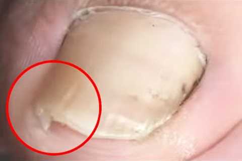 Rescuing a Trapped Ingrown Toenail【Crazy pedicure room】