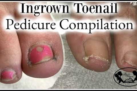 👣Satisfying Ingrown Toenail Pedicure Compilation👣