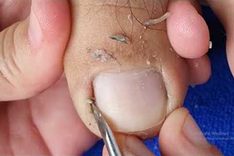 PEDICURE OF A MALE TOENAILS TUTORIAL | REMOVING INGROWN IN TOENAILS | SATISFYING VIDEO