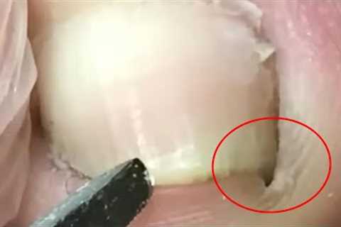 The ingrown nail is so deep！This patient walks with pain【 Crazy pedicure room】