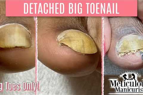 👣Big Toes Only - How To Pedicure Transformation for Men on Detached Toenails👣