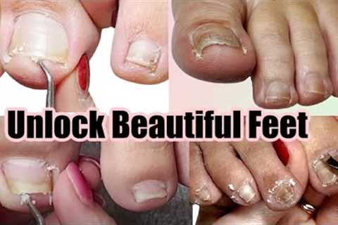 Reveal Radiant Feet: Pedicure Compilation for Impacted, Ingrown, + Pincer Toenails! (part 1)