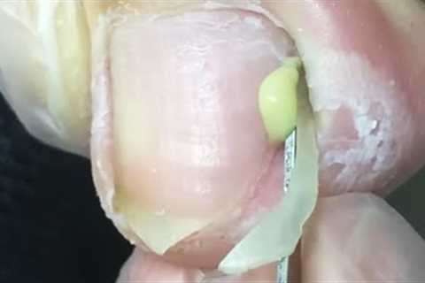 Pedicure video collection: professional ingrown toenail trimming~【Crazy pedicure room】