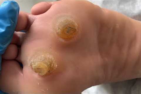 Wow! full version! Incredible plantar calluses/like two eyes【Xiao Yan Pedicure】Vertical screen  1106