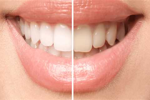 What is the Best Treatment to Whiten Teeth