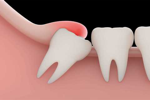 What is the recovery time for Cosmetic Dentistry -