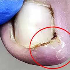 Pedicure Tutorial：Ingrown nails under swollen toes【Pedicure Master Lin Jun】