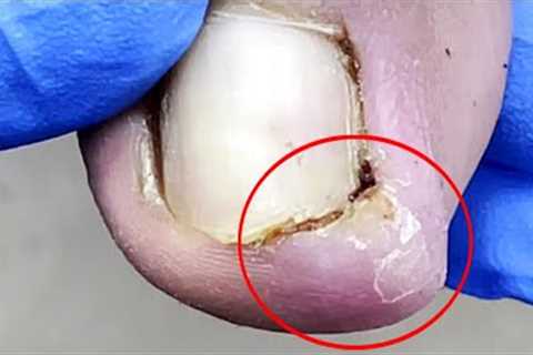 Pedicure Tutorial：Ingrown nails under swollen toes【Pedicure Master Lin Jun】